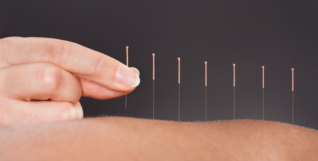 Phục hồi cải thiện di chứng sau đột quỵ Châm cứu phục hồi sau đột quỵ