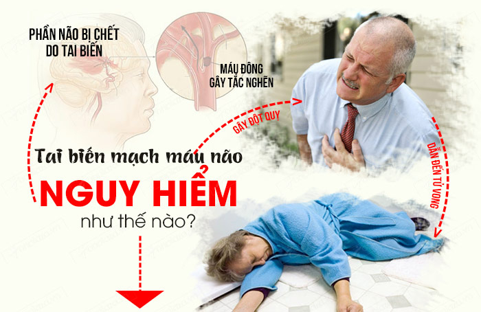 Tai viến mạch máu não nguy hiểm như thế nào?