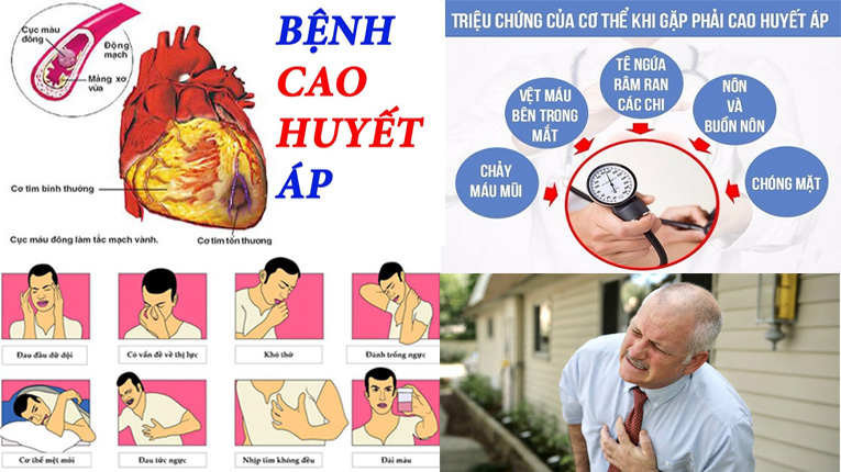 Vì sao rối loạn mỡ máu cao làm tăng huyết áp? Cách điều hòa mỡ máu và kiểm soát tăng huyết áp