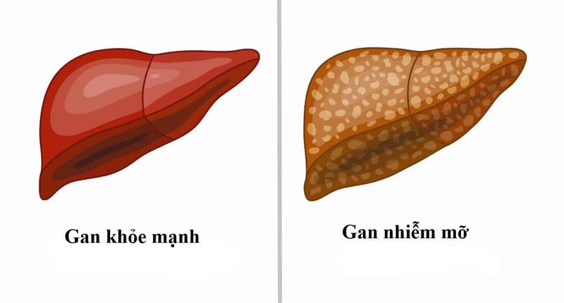 Mỡ máu cao gây ra bệnh gan nhiễm mỡ