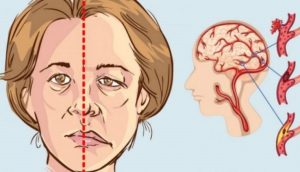 đột quỵ tai biến mạch máu não