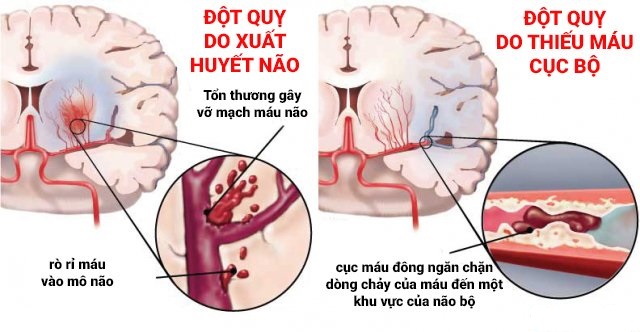 tai biến mạch máu não