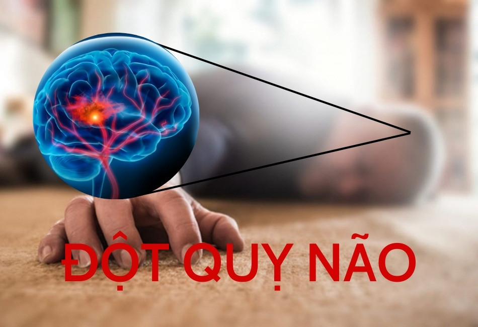 Đột quỵ não: Cần xử trí sớm và đúng cách Đột quỵ não