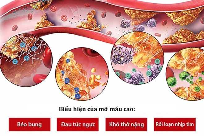 Những biến chứng nguy hiểm rối loạn mỡ máu Biểu hiện của mỡ máu cao