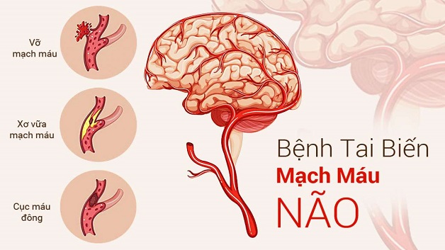 đột quỵ tai biến mạch máu não