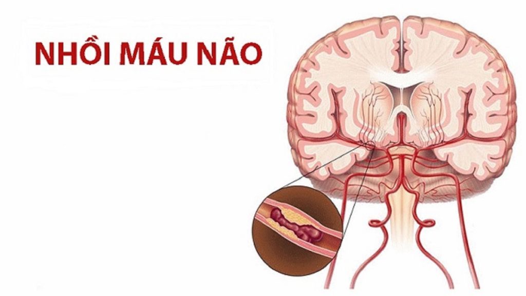 Nhồi máu não: Những điều cần biết để phòng trách nhồi máu não