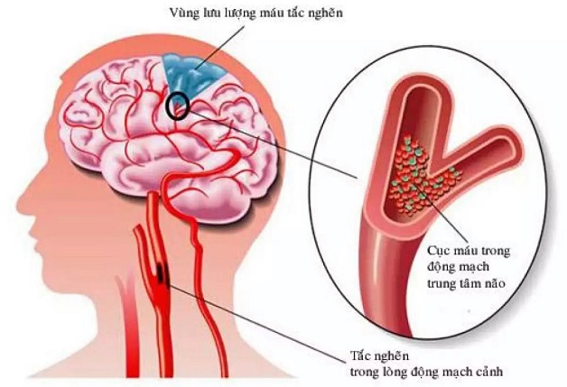 Nhồi máu não: Những điều cần biết để phòng trách nhồi máu não