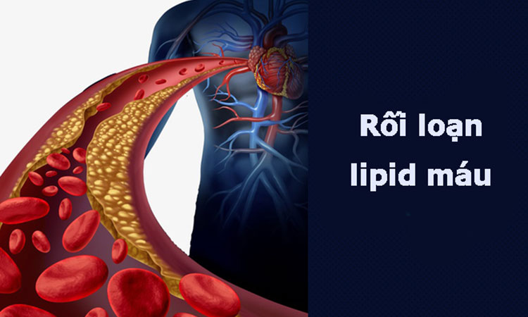 RỐI LOẠN LIPID MÁU: NGUYÊN NHÂN, BIẾN CHỨNG VÀ PHÒNG NGỪA Rối loạn lipid máu