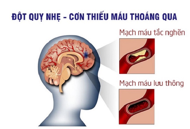 đột quỵ thoáng qua
