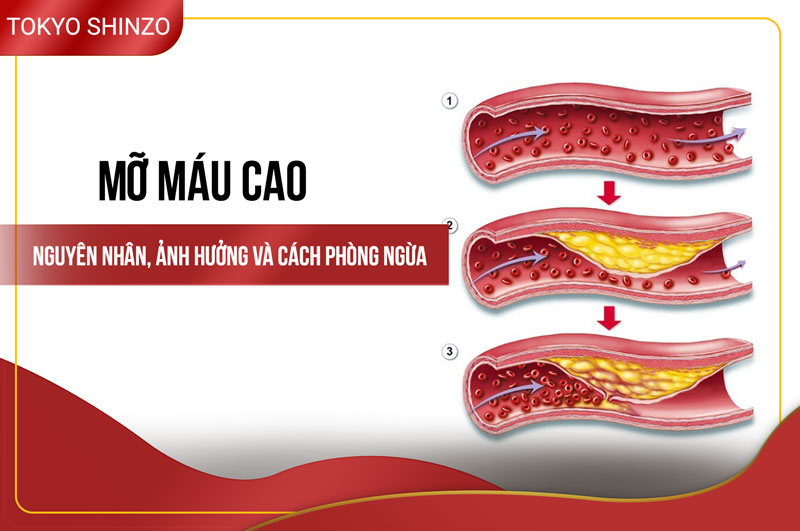 Mỡ máu cao - Nguyên nhân, ảnh hưởng và cách phòng ngừa Mo mau cao