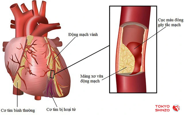 Mỡ máu cao - Nguyên nhân, ảnh hưởng và cách phòng ngừa bệnh tim mạch do mỡ máu cao