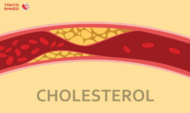 Cholesterol và Triglyceride: Hai Yếu tố Liên Quan Đến Sức Khỏe Tim Mạch Cholesterol