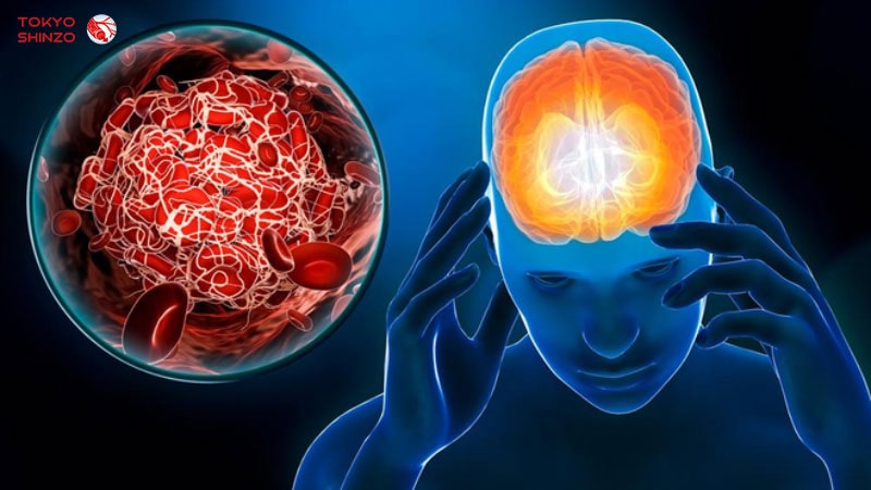Nguyên nhân, triệu chứng và cách phòng ngừa bệnh đột quỵ não hiệu quả bệnh đột quỵ não