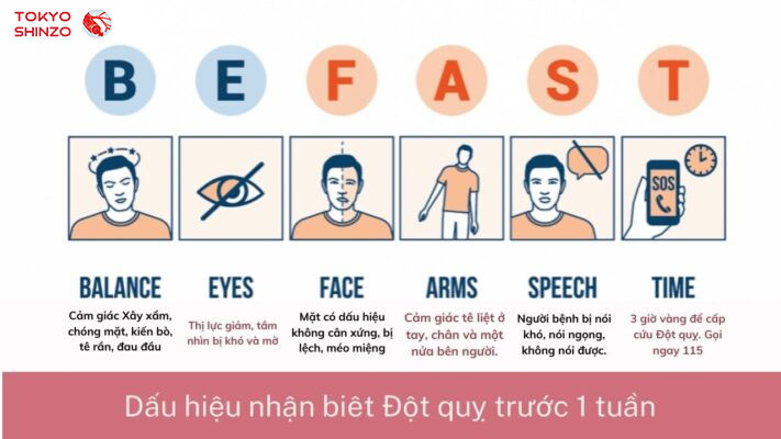 dấu hiệu nhận biết đột quỵ trước 1 tuần