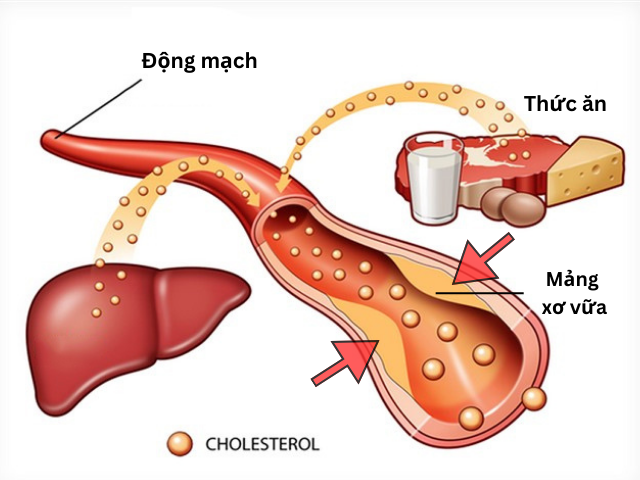Rối loạn chuyển hóa mỡ máu là nguyên nhân làm tăng tỷ lệ đột quỵ ở người trẻ